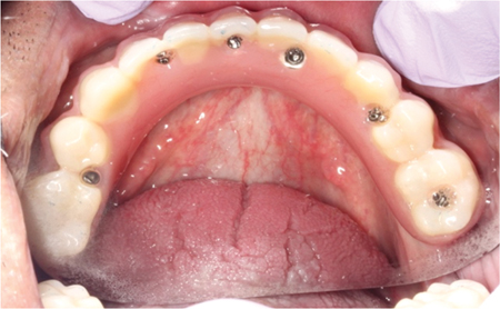 Screw-retained full arch hybrid prosthesis prior to removal for maintenance.