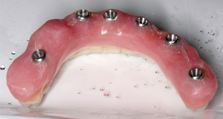 Prosthesis after concavities have been modified by a combination of filling in with acrylic and polishing/flattening.