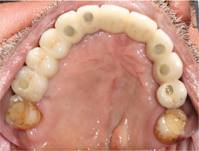 The patient presented with a full arch bridge scheduled for annual maintenance.