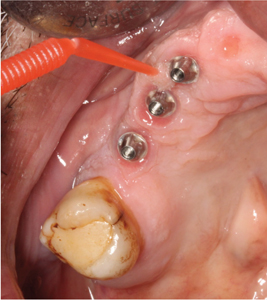 Food debris and plaque around the abutments were removed using a micro-brush and chlorhexidine 0.12%.