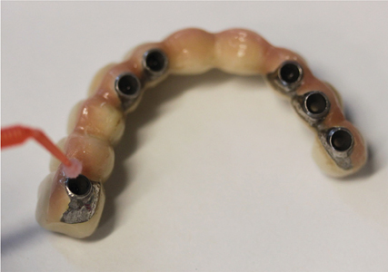 . Cleaning the prosthetic screw chambers with a micro-brush and chlorhexidine 0.12%.