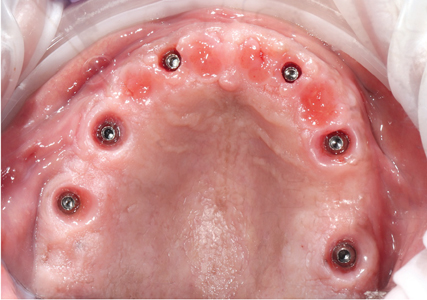 Healthy peri-implant soft tissue visible upon removal of a full arch implant prosthesis