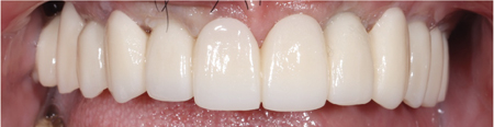 Visual inspection of FP1 style zirconia prosthesis prior to removal for maintenance.