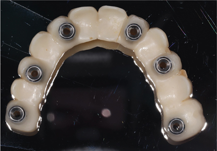 . Visual inspection of the intaglio surface of the FP1 zirconia prosthesis