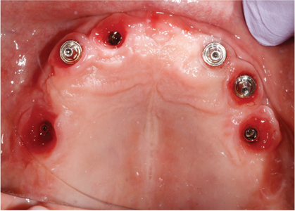 Peri-implant mucositis visible mostly around implants that do not have multi-unit abutments.