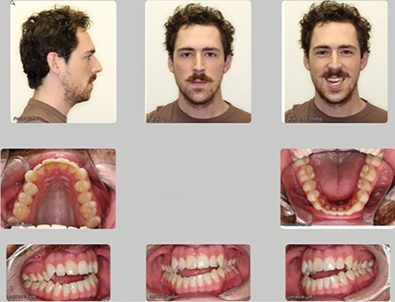  Combination surgery involving both the upper and lower jaws, dramatically improving his occlusion, function, and smile.