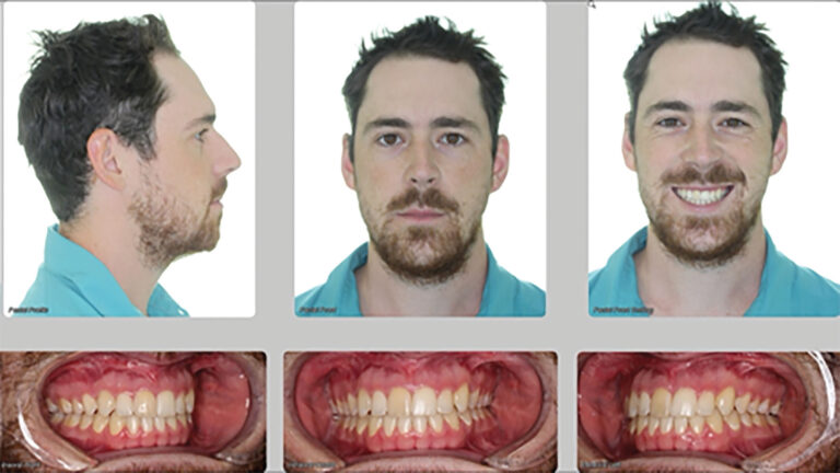  Combination surgery involving both the upper and lower jaws, dramatically improving his occlusion, function, and smile.