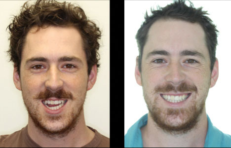  Combination surgery involving both the upper and lower jaws, dramatically improving his occlusion, function, and smile.