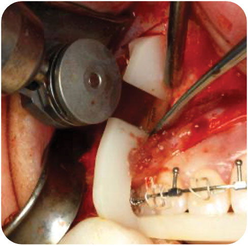 Segmental osteotomy using a sagittal saw and a cutting guide to aid in cases with limited inter-radicular space. (IPS, KLS Martin, Jacksonville, USA). 