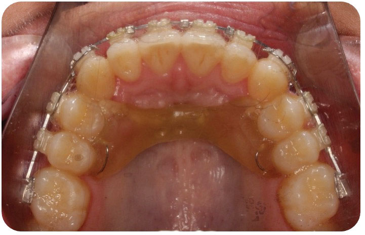  Insertion of a 3D-printed palatal strut that is wired to the patient’s dentition and aids in maintaining transverse expansion post-operatively. (3D Systems, Rock Hill, USA).  