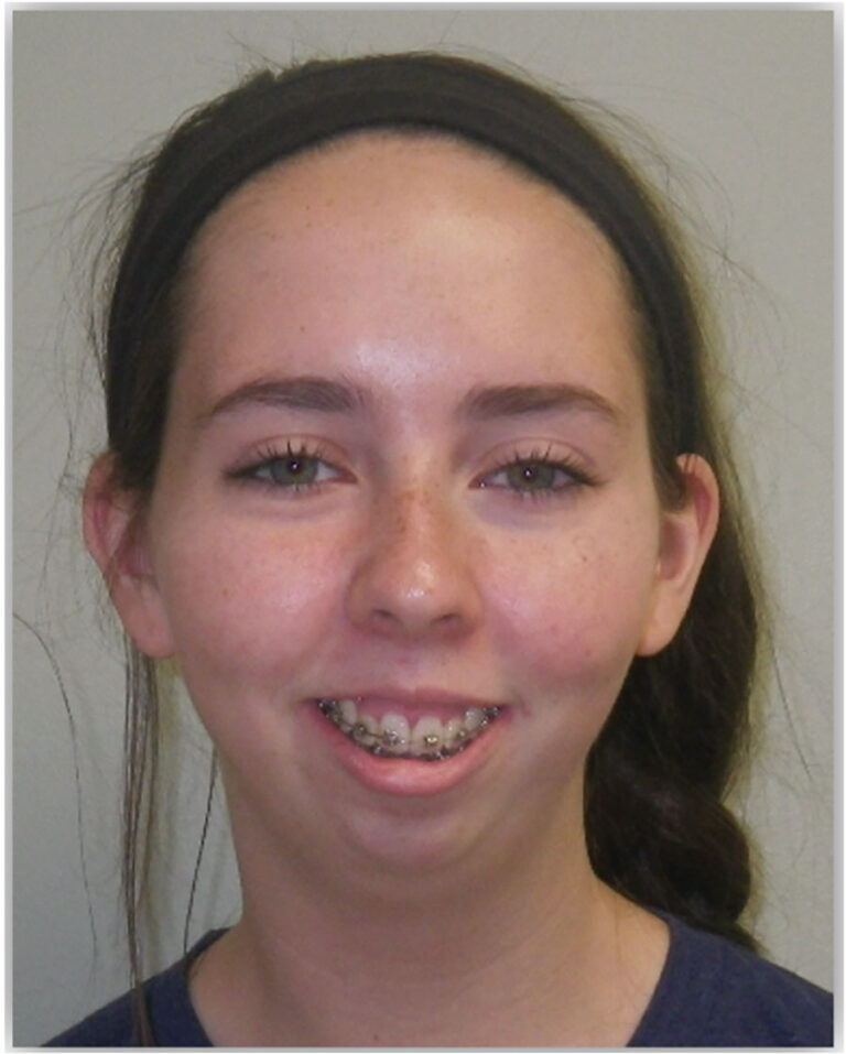  Bimaxillary surgery involving an inverted L osteotomy, dramatically improving her occlusion, function, and smile. Note the lack of neck incisions or extra-oral scar. (IPS, KLS Martin, Jacksonville, USA).