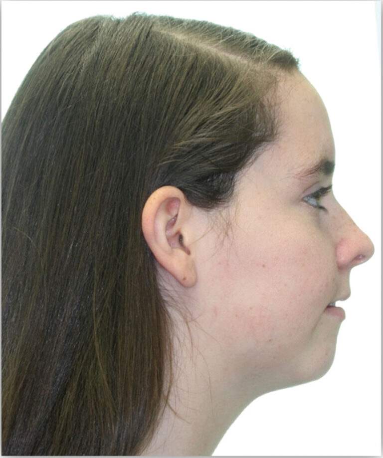 Bimaxillary surgery involving an inverted L osteotomy, dramatically improving her occlusion, function, and smile. Note the lack of neck incisions or extra-oral scar. (IPS, KLS Martin, Jacksonville, USA).