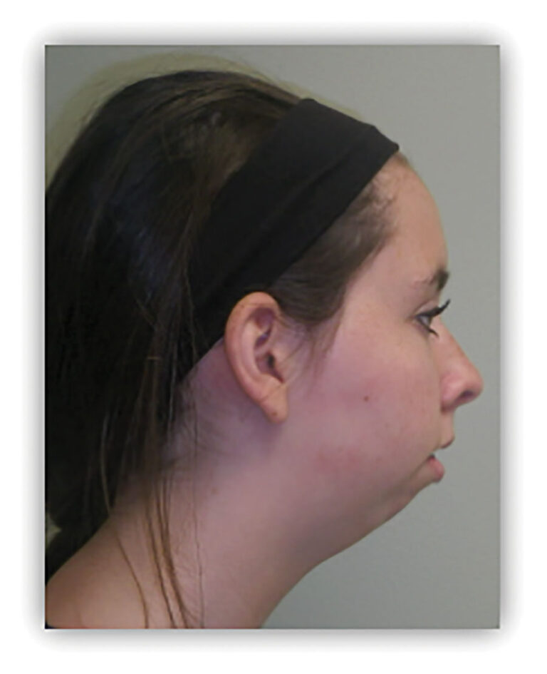 Bimaxillary surgery involving an inverted L osteotomy, dramatically improving her occlusion, function, and smile. Note the lack of neck incisions or extra-oral scar. (IPS, KLS Martin, Jacksonville, USA).