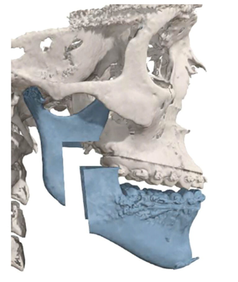  Bimaxillary surgery involving an inverted L osteotomy, dramatically improving her occlusion, function, and smile. Note the lack of neck incisions or extra-oral scar. (IPS, KLS Martin, Jacksonville, USA).