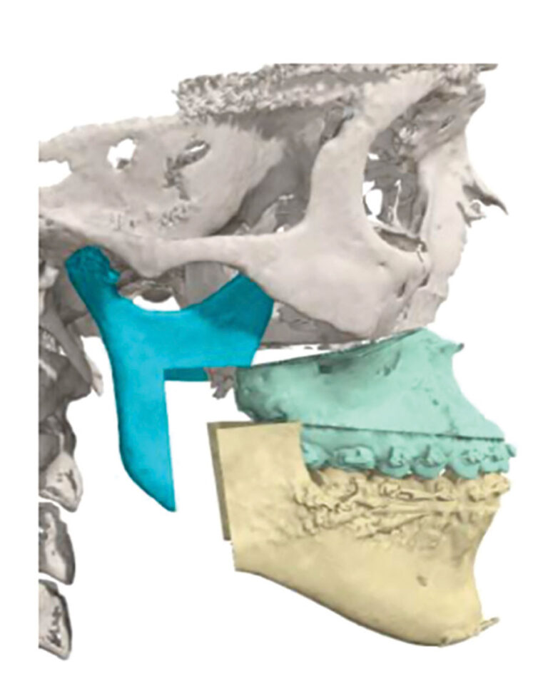 Bimaxillary surgery involving an inverted L osteotomy, dramatically improving her occlusion, function, and smile. Note the lack of neck incisions or extra-oral scar. (IPS, KLS Martin, Jacksonville, USA).