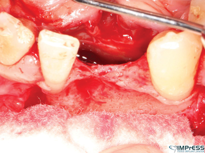 Thin and concave residual ridge