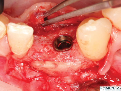 Implant successfully placed in high quality bone.