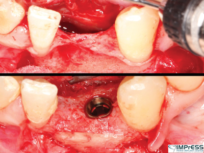 . Initial pre-operative view and robust grafted ridge with implant inserted.