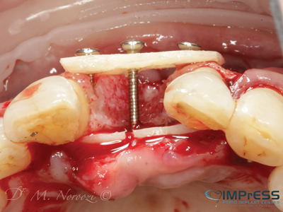 . Autogenous bone from mandibular external oblique ridge secured with screws to create a box.