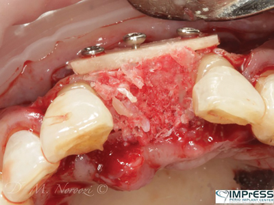 Additional autogenous graft fills the box