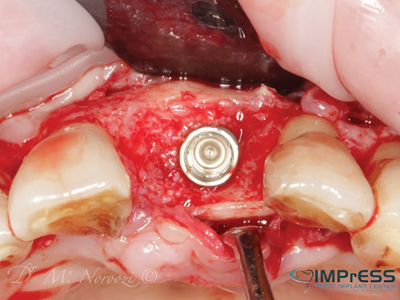 . Implant placed in robust grafted ridge.