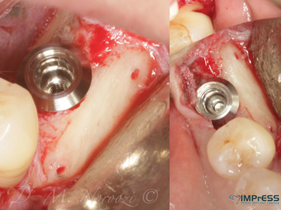 Implant inserted in the grafted and healed ridge.