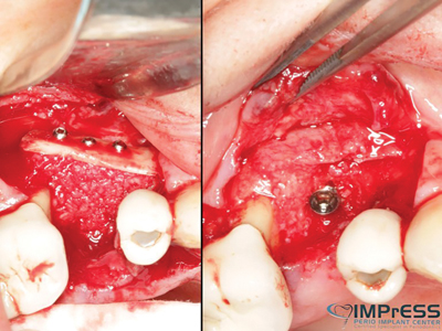 Additional autogenous bone graft placed, and at re-entry with implant placed.