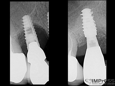 Pre and post operative radiographs.