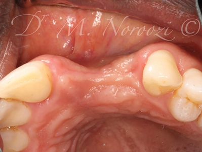 Preoperative intraoral view.