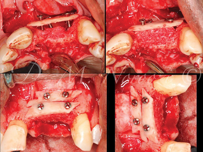 Grafting procedure with 2 segments of autogenous cortical bone, and additional autogenous graft filling the gap.