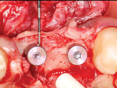 Thick bone present at the buccal aspect of 22 and 21 implants.