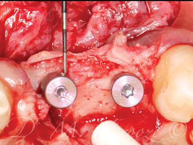  Thick bone present at the buccal aspect of 22 and 21 implants.