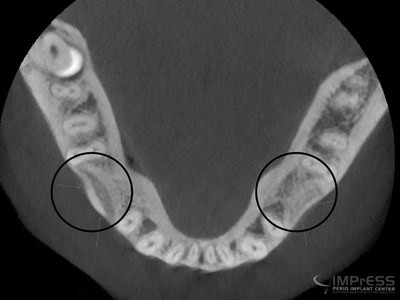 . CBCT of healed grafted ridge.
