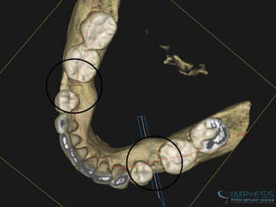 CBCT of healed grafted ridge.