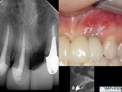 Preoperative radiograph, clinical 
view and CBCT of maxillary anterior.  
