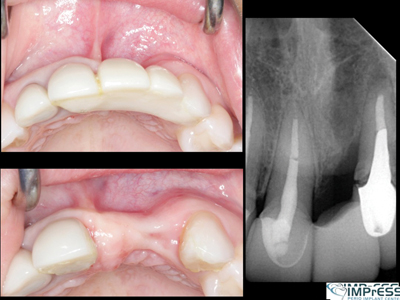 Occlusal view of healed 22 extraction