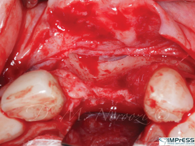 Residual ridge presenting vertical and horizontal bone loss.