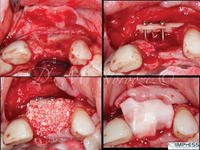 Autogenous bone graft.