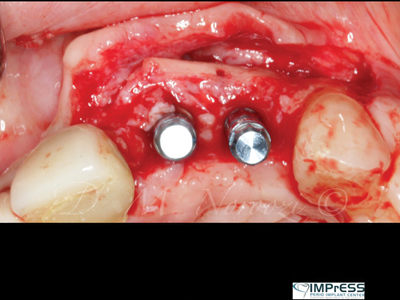 Prepared 21 and 22 implant sites.