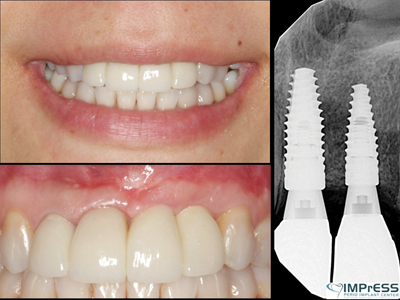 Extraoral intraoral and radiograph of integrated and restored implants.