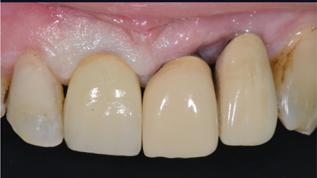 Presurgical View 11/21/22-Oral Implant Restorations and proximal tissue deficiency between teeth 21/22 as well as proximal space between teeth 12-22.  