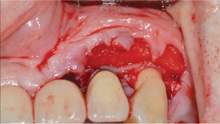  Surgical access and placement apical base layer of collagenous tissue. 