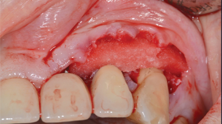  Placement of coronal layer of collagen. 