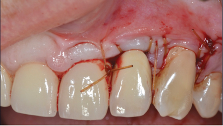 CRAFT Tissue Management and Surgical Closure with S-Loops