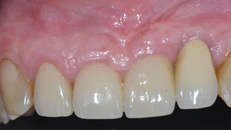  Post Surgical healing 3 years follow up