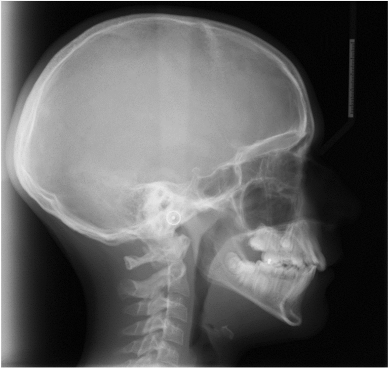 Pre-treatment untraced cephalometric radiograph.