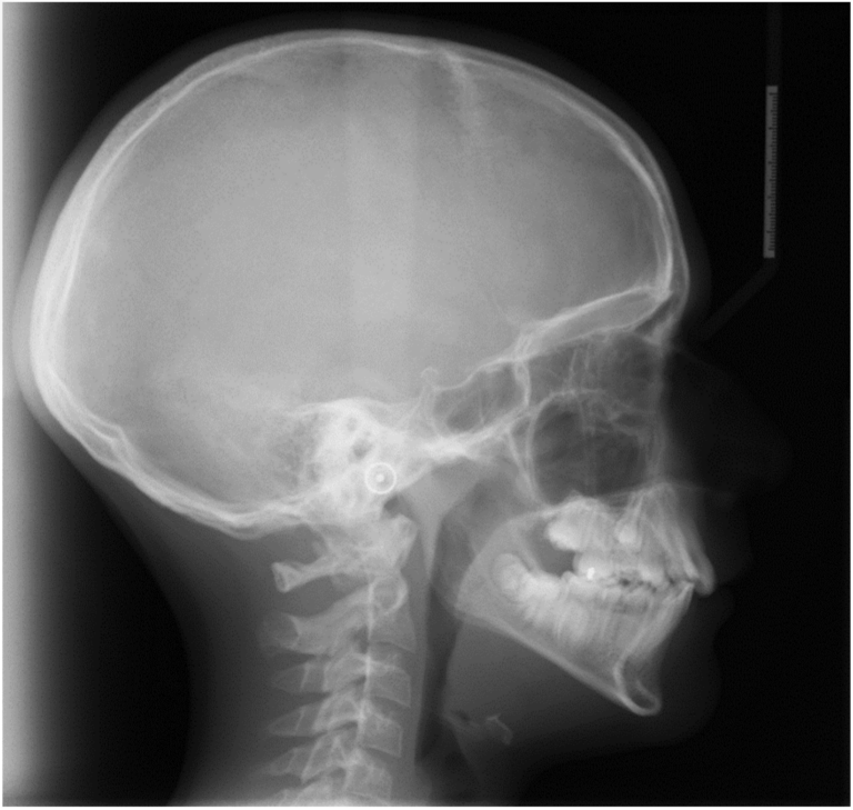 Pre-treatment untraced cephalometric radiograph.  
