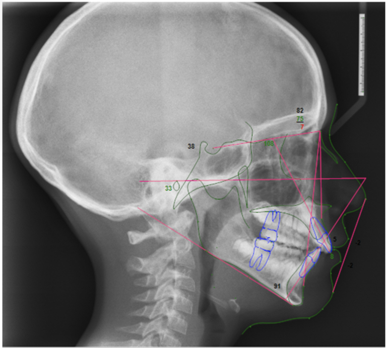 Pre-treatment traced cephalometric radiograph.