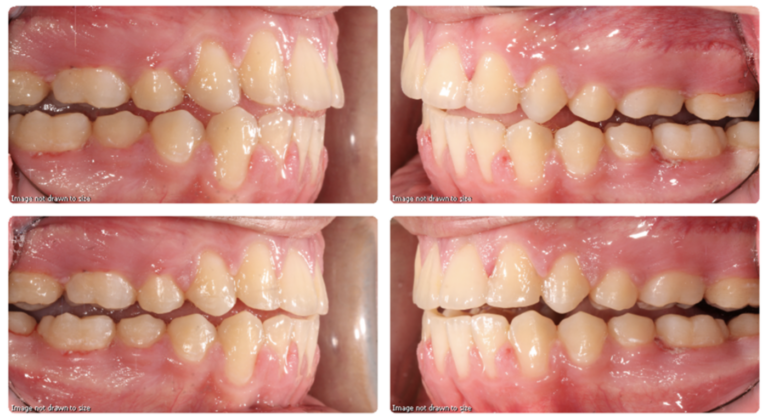 aphs showing the guidance on the working sides (top photographs) and a lack of interferences on the non-working sides (bottom photographs).