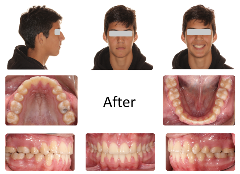 Post-treatment intra and extra-oral image.